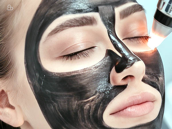 Carbon laser peel treatment for oily skin, pigmentation, and deep pore cleansing